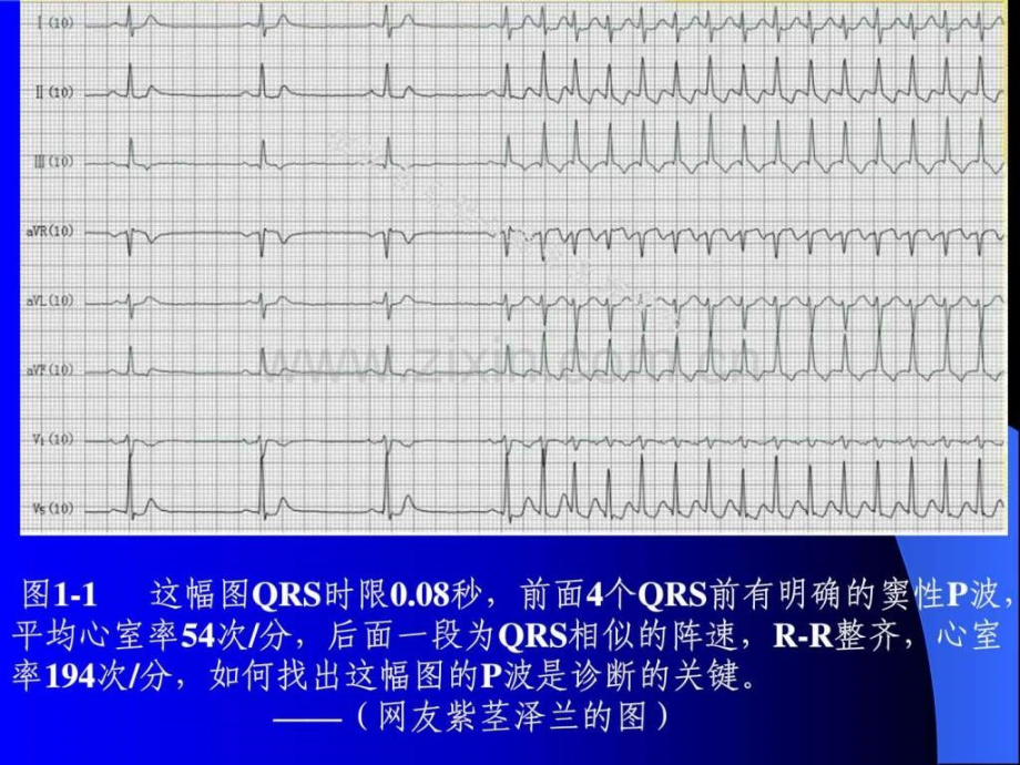 P波的识别与相关病例讨图文.pptx_第2页