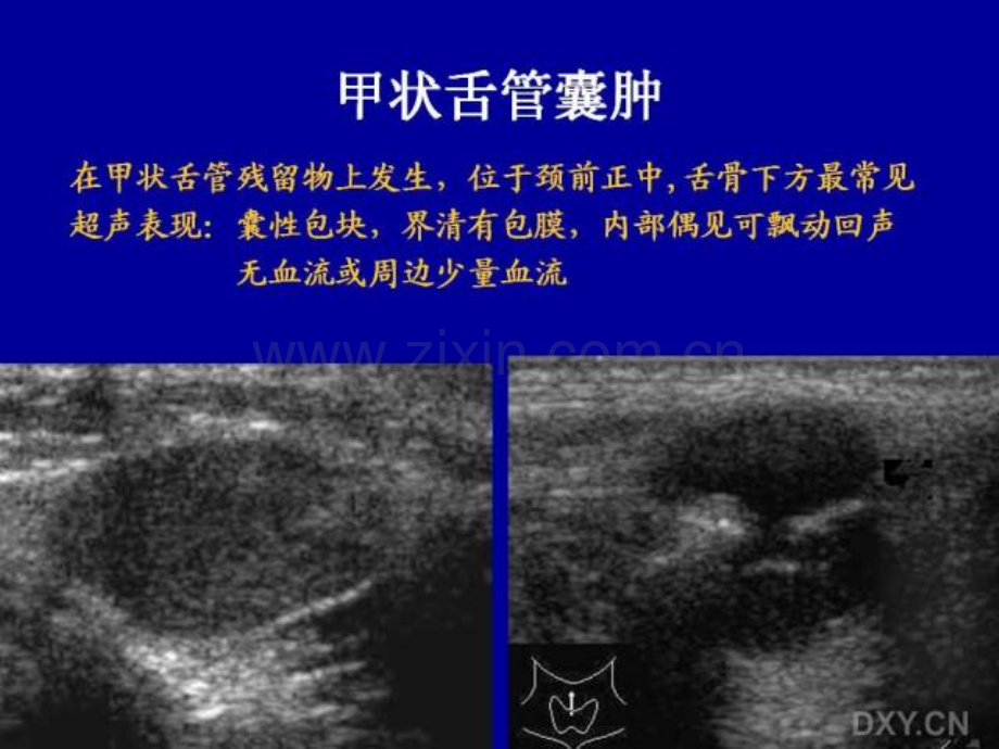 讲座颈部常见肿物的超声诊断.pptx_第2页