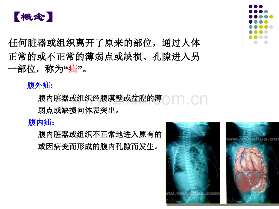 腹外疝临床医学课件.pptx_第1页