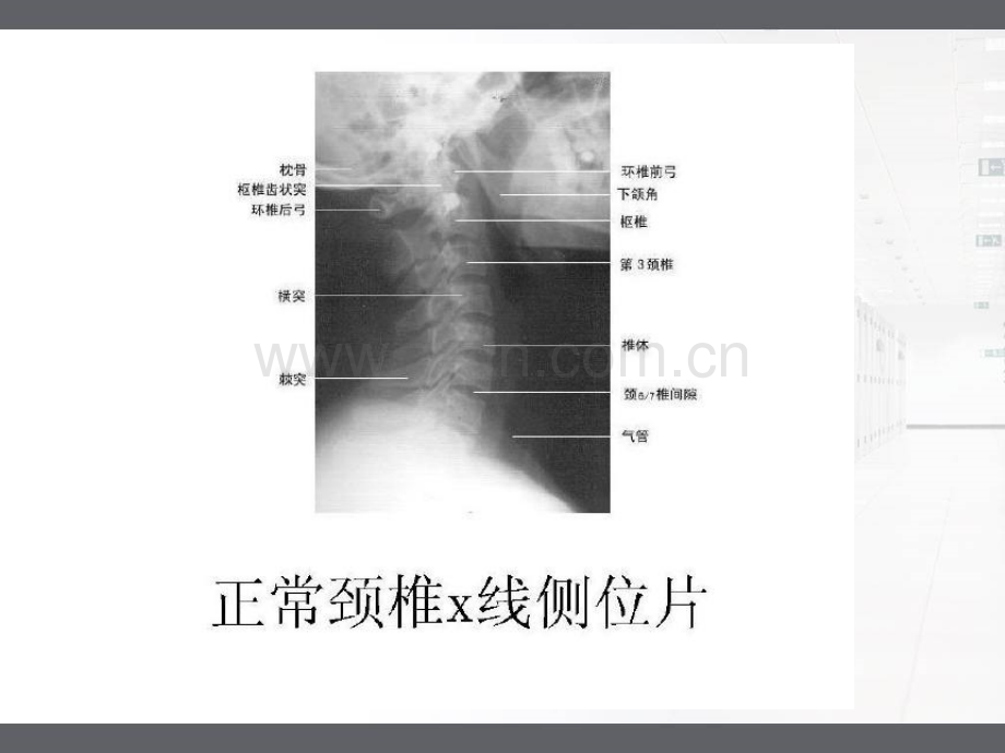 枕颌带牵引的护理..pptx_第2页