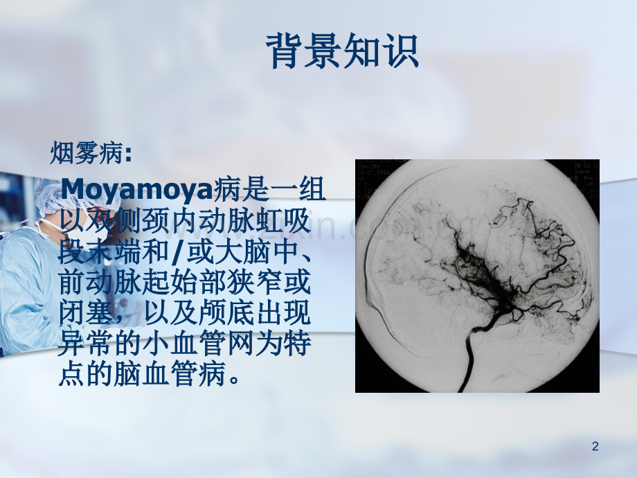 烟雾病颅内外血管搭桥治疗缺血性脑血管疾病.pptx_第2页