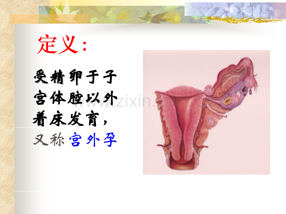 宫外孕的护理.pptx_第1页