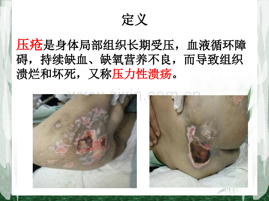 压疮护理查房刘曼详解.pptx_第2页