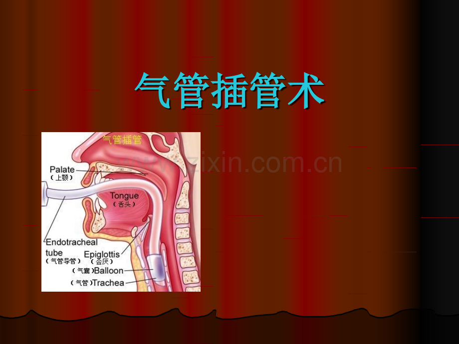 气管插管技术讲课.pptx_第1页