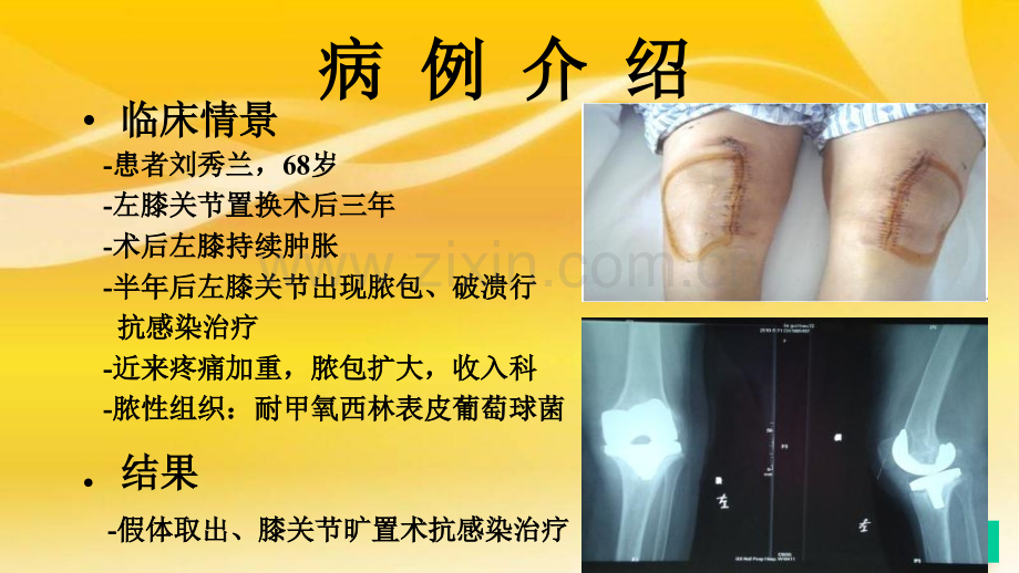 关节置换术后多重耐药菌感染.pptx_第2页