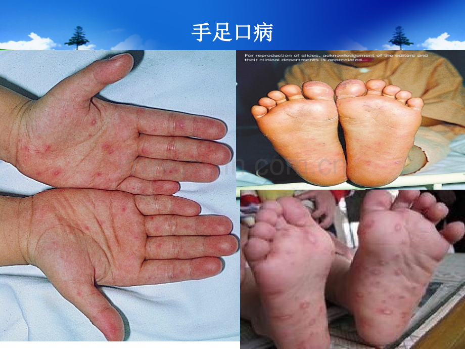 手足口病防治.pptx_第2页