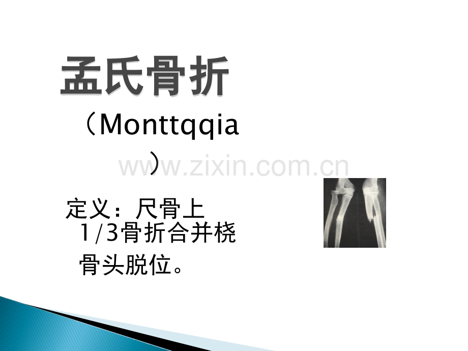 孟氏骨折与盖氏骨折.pptx_第1页