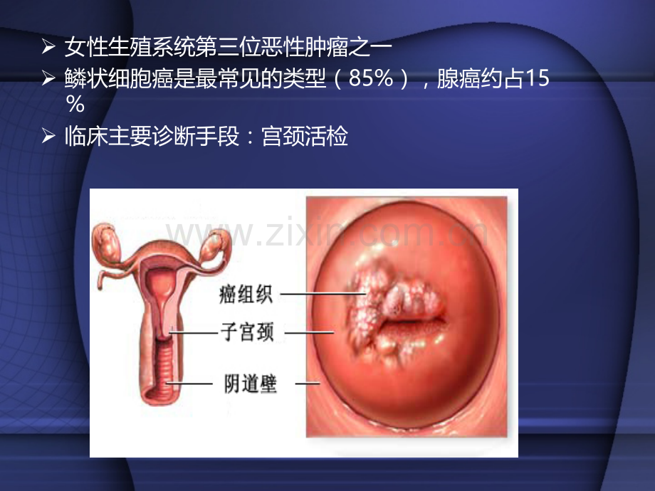 宫颈癌靶区勾画.pptx_第2页