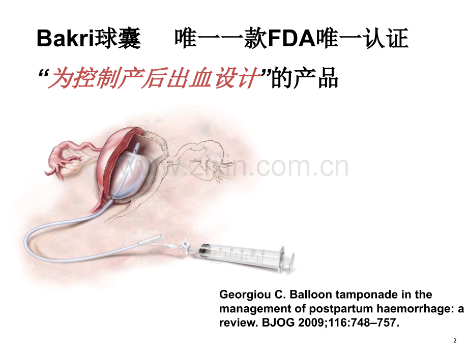 BAKRI子宫填塞球囊导管.pptx_第2页