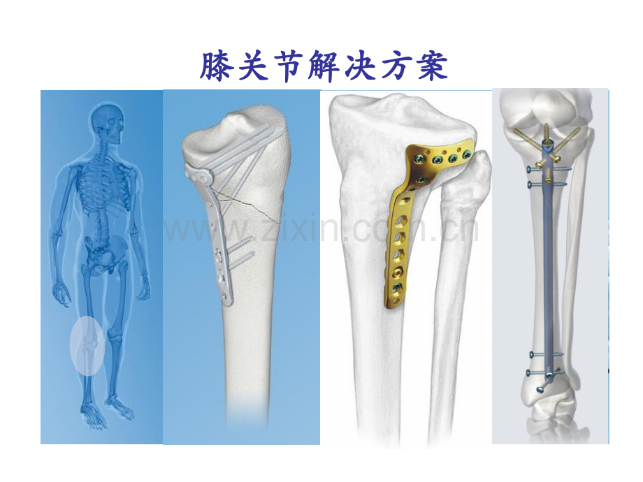 ao膝关节骨折.pptx_第1页