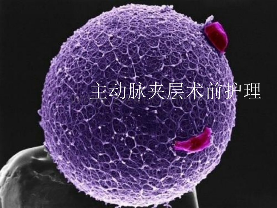 主动脉夹层术前护理概要.pptx_第1页