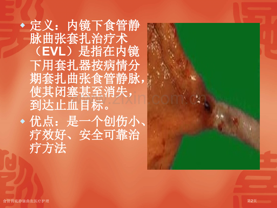 食管胃底静脉曲张医疗护理.pptx_第2页