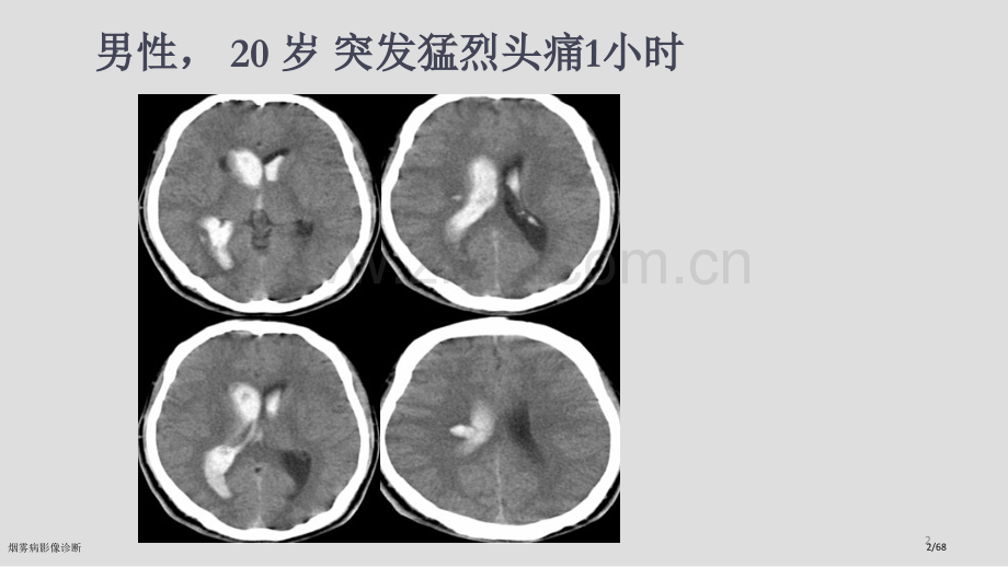 烟雾病影像诊断.pptx_第2页
