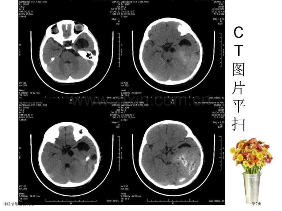 神经节细胞胶质瘤.pptx_第2页