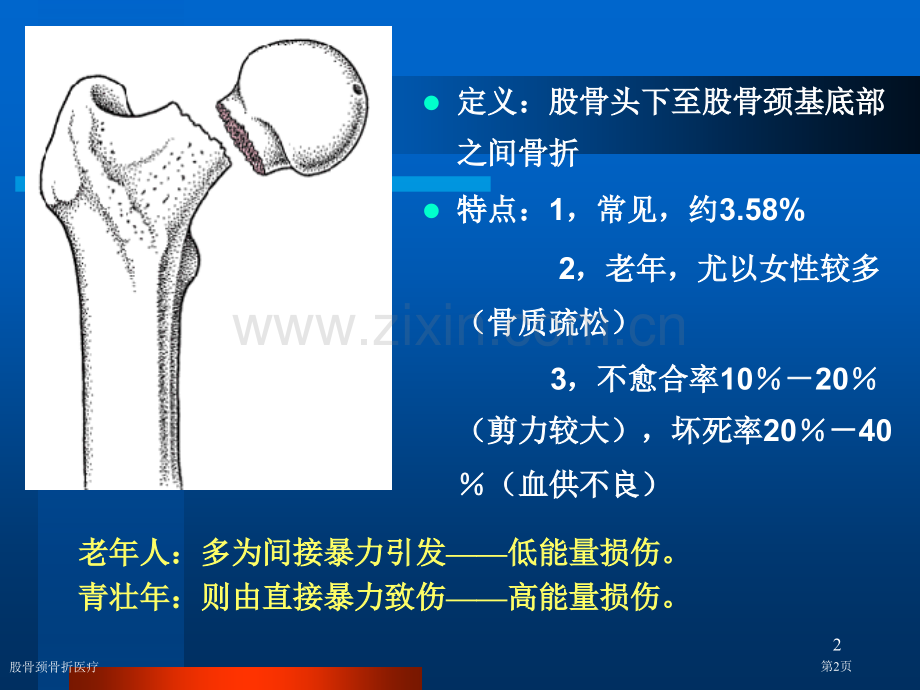 股骨颈骨折医疗.pptx_第2页