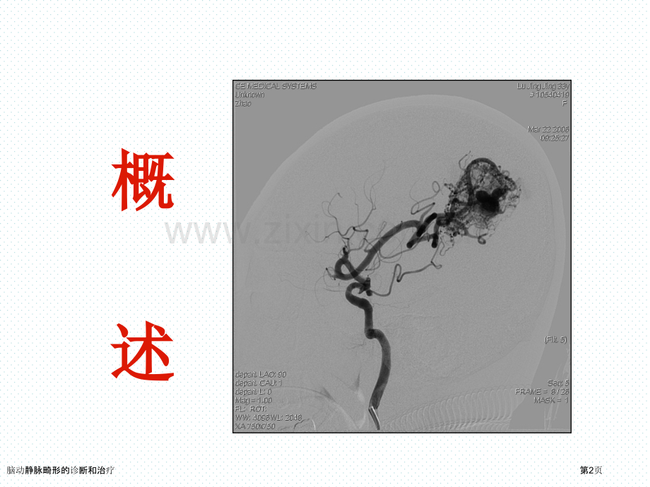 脑动静脉畸形的诊断和治疗.pptx_第2页