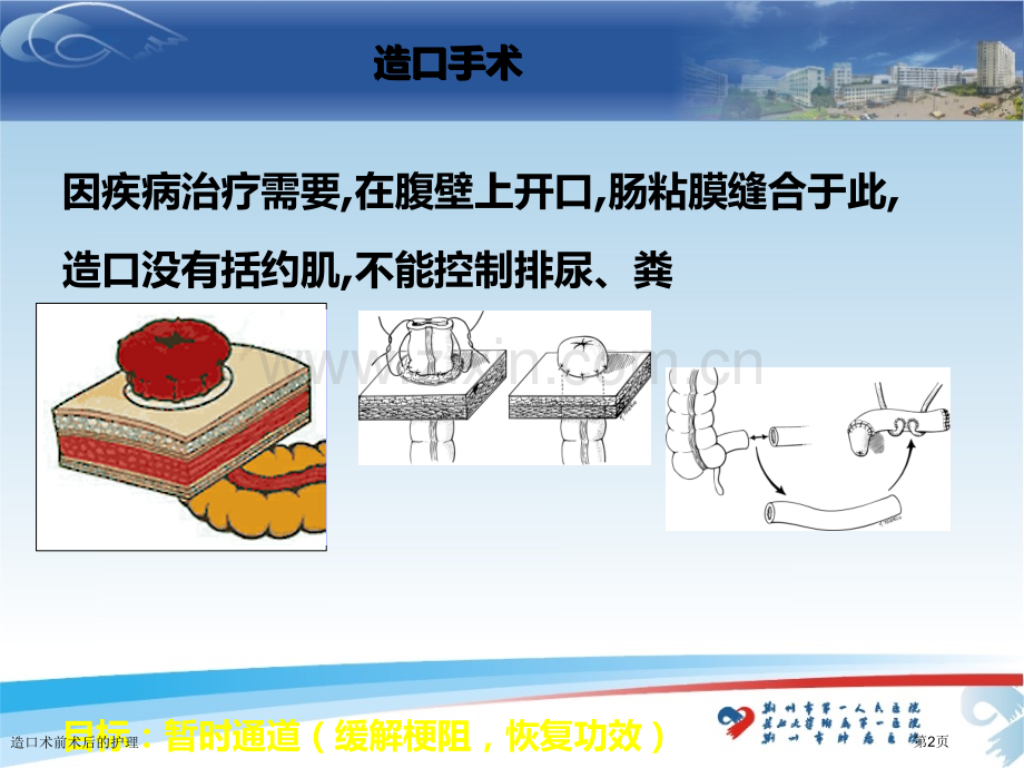造口术前术后的护理.pptx_第2页