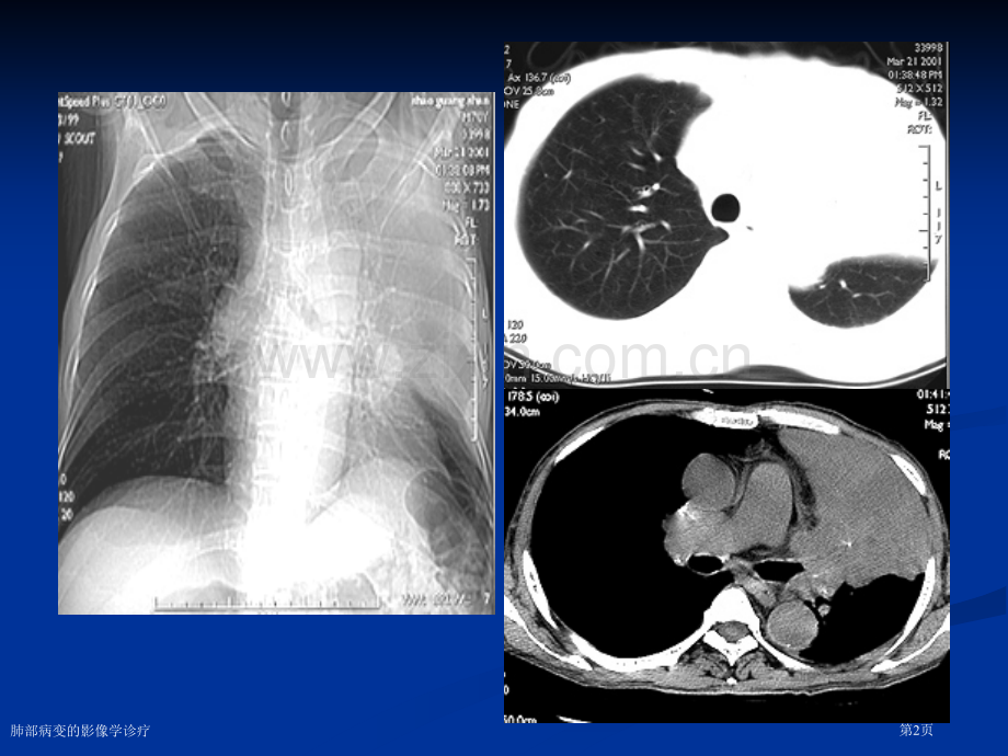 肺部病变的影像学诊疗专家讲座.pptx_第2页