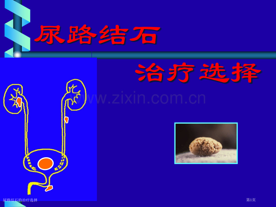 尿路结石的治疗选择专家讲座.pptx_第1页