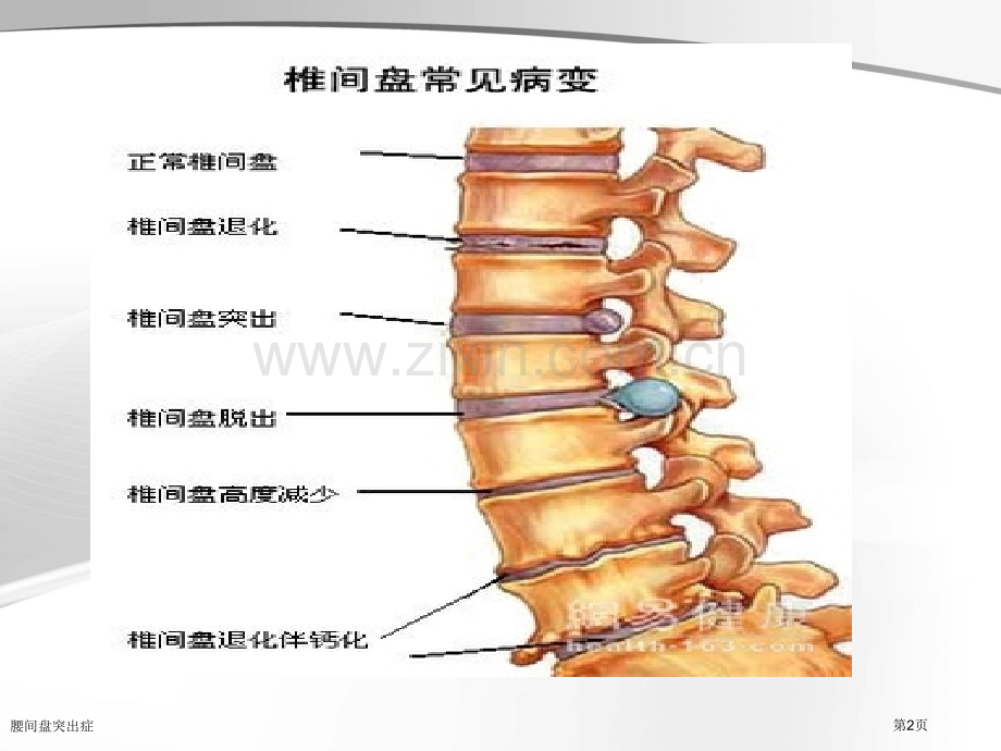 腰间盘突出症.pptx_第2页