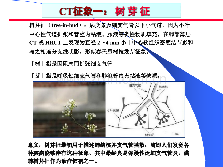 肺部CT十大征象诊断应用专题医学知识宣讲.pptx_第2页