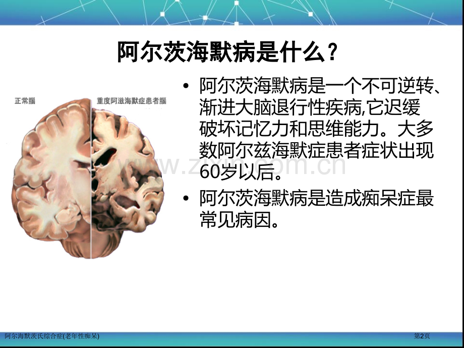 阿尔海默茨氏综合症(老年性痴呆)专家讲座.pptx_第2页