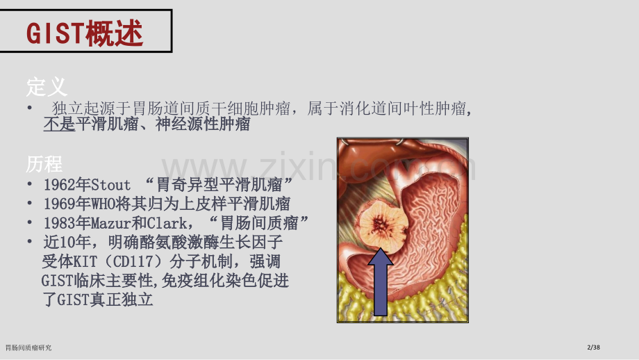 胃肠间质瘤研究.pptx_第2页