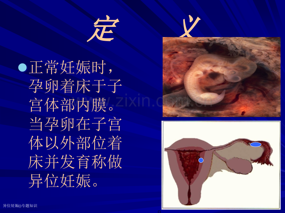 异位妊娠专题知识专家讲座.pptx_第2页