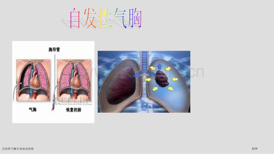 自发性气胸专业知识讲座.pptx_第2页