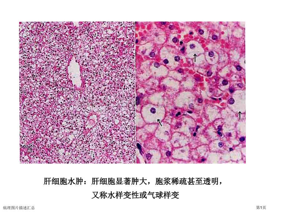 病理图片描述汇总.pptx_第1页