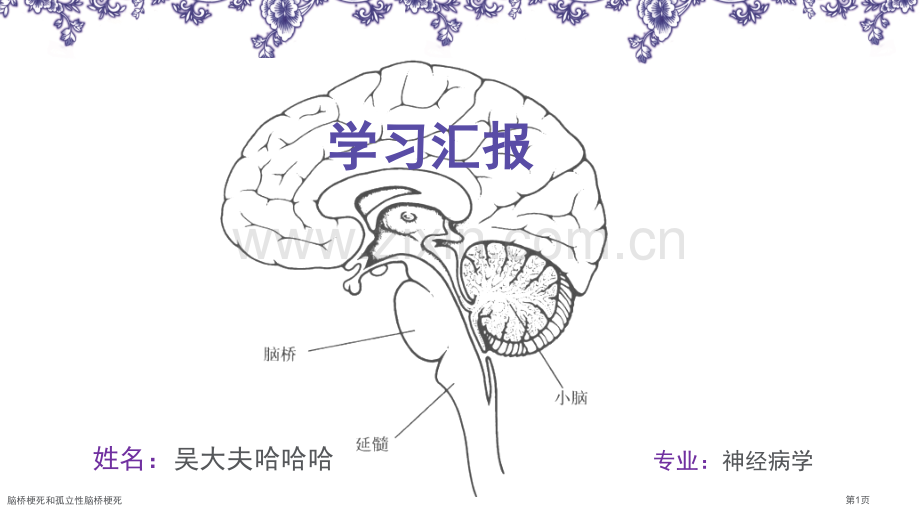 脑桥梗死和孤立性脑桥梗死.pptx_第1页