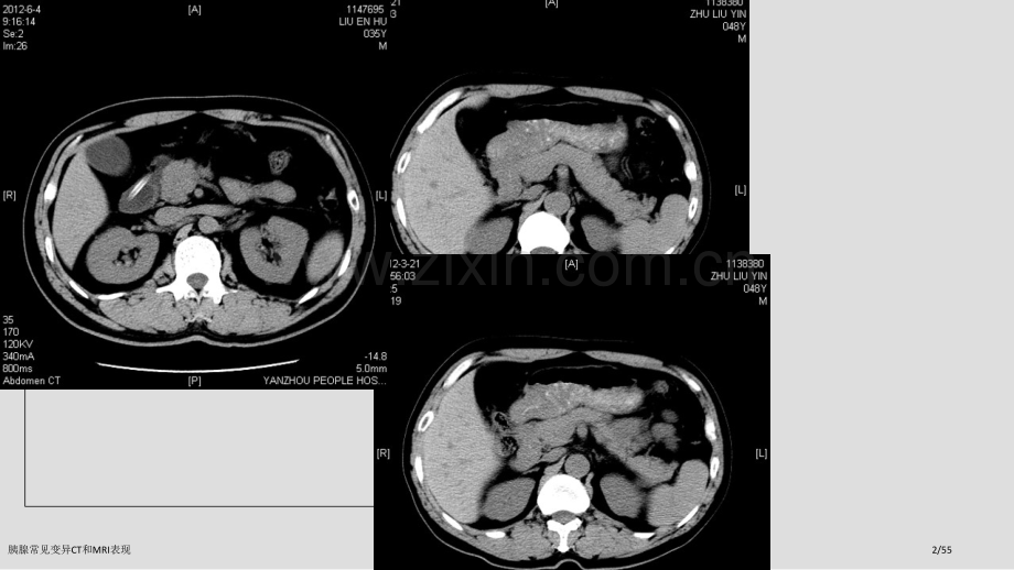 胰腺常见变异CT和MRI表现.pptx_第2页