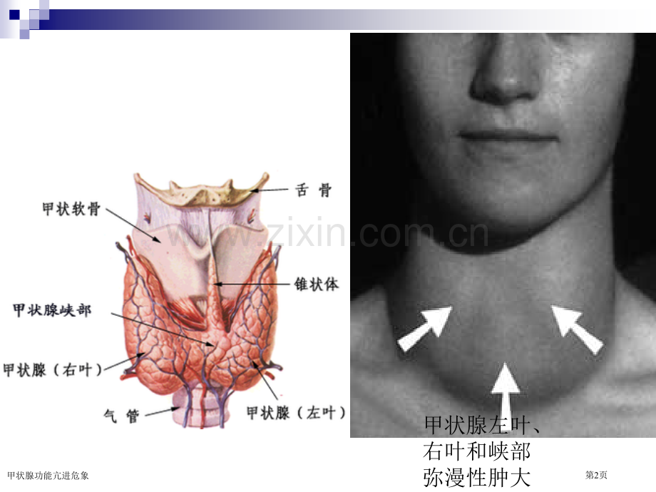 甲状腺功能亢进危象.pptx_第2页