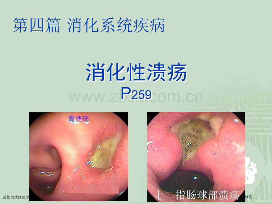 消化性溃疡医学知识专家讲座.pptx_第1页