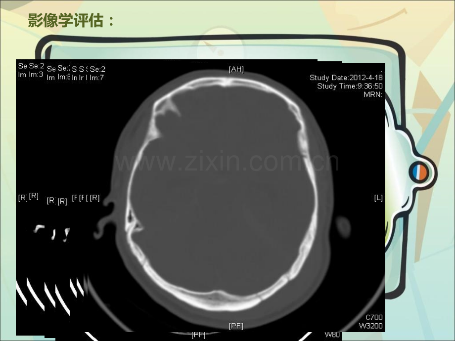 颅内压监测在重型颅脑损伤治疗中的应用.pptx_第2页