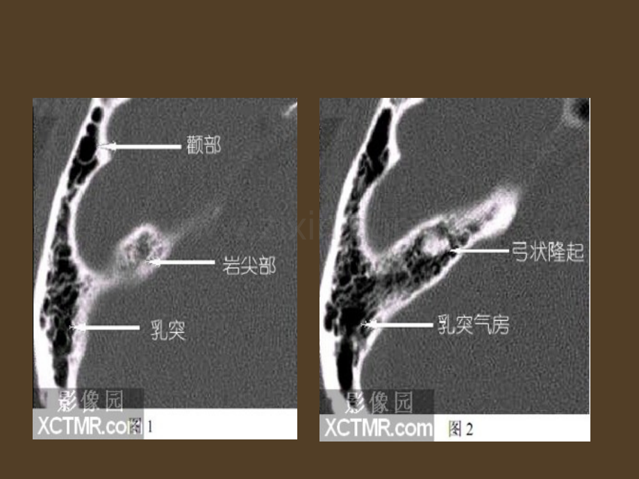 耳部最详细ct解剖课件.pptx_第2页