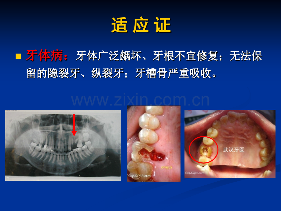 第六章拔牙术.ppt_第2页