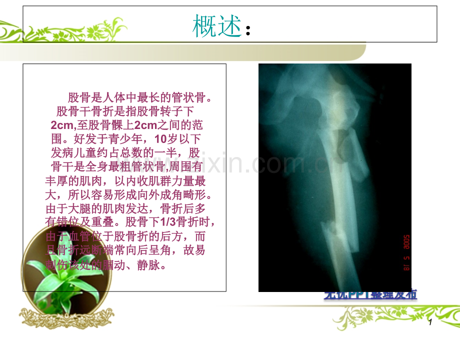股骨干骨折的康复护理.ppt_第1页