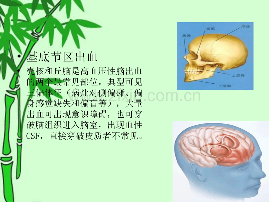 右侧基底节区脑出血课件.ppt_第1页
