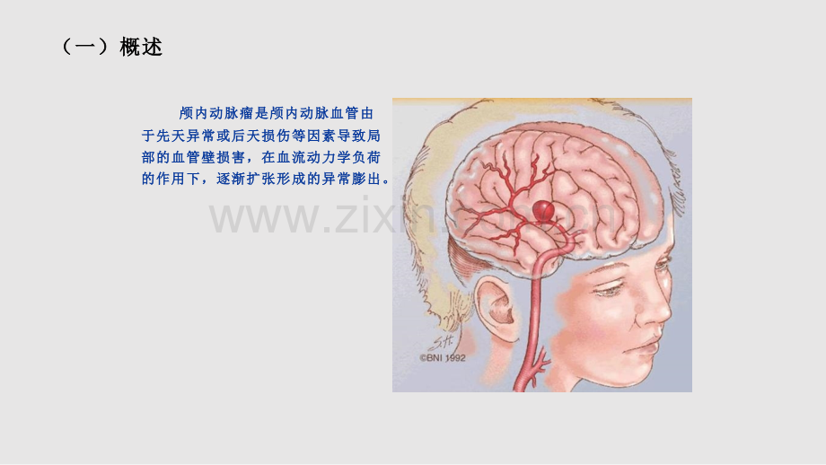 颅内动脉瘤疾病查房学习PPT教案.pptx_第2页