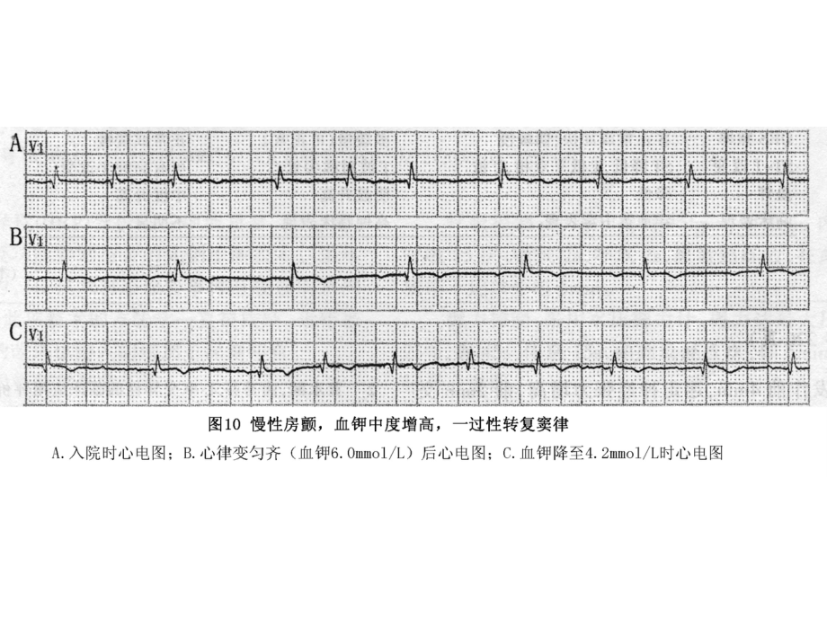 房颤心电图课件.ppt_第1页
