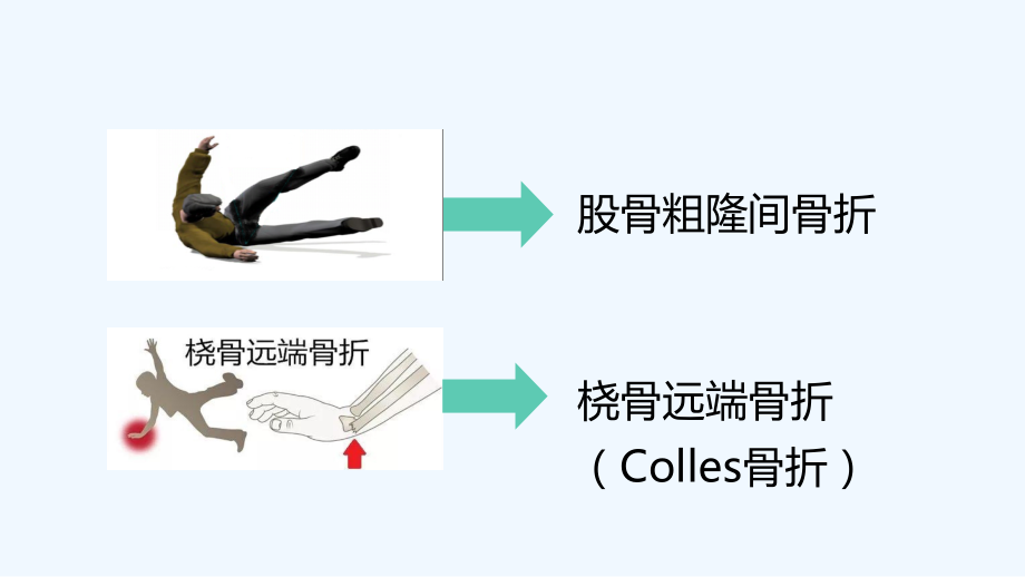 股骨粗隆间骨折-.ppt_第2页