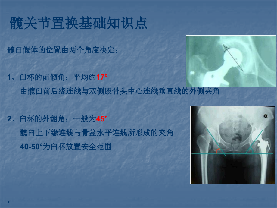 人工髋关节置换基础知识点PPT医学.pptx_第2页