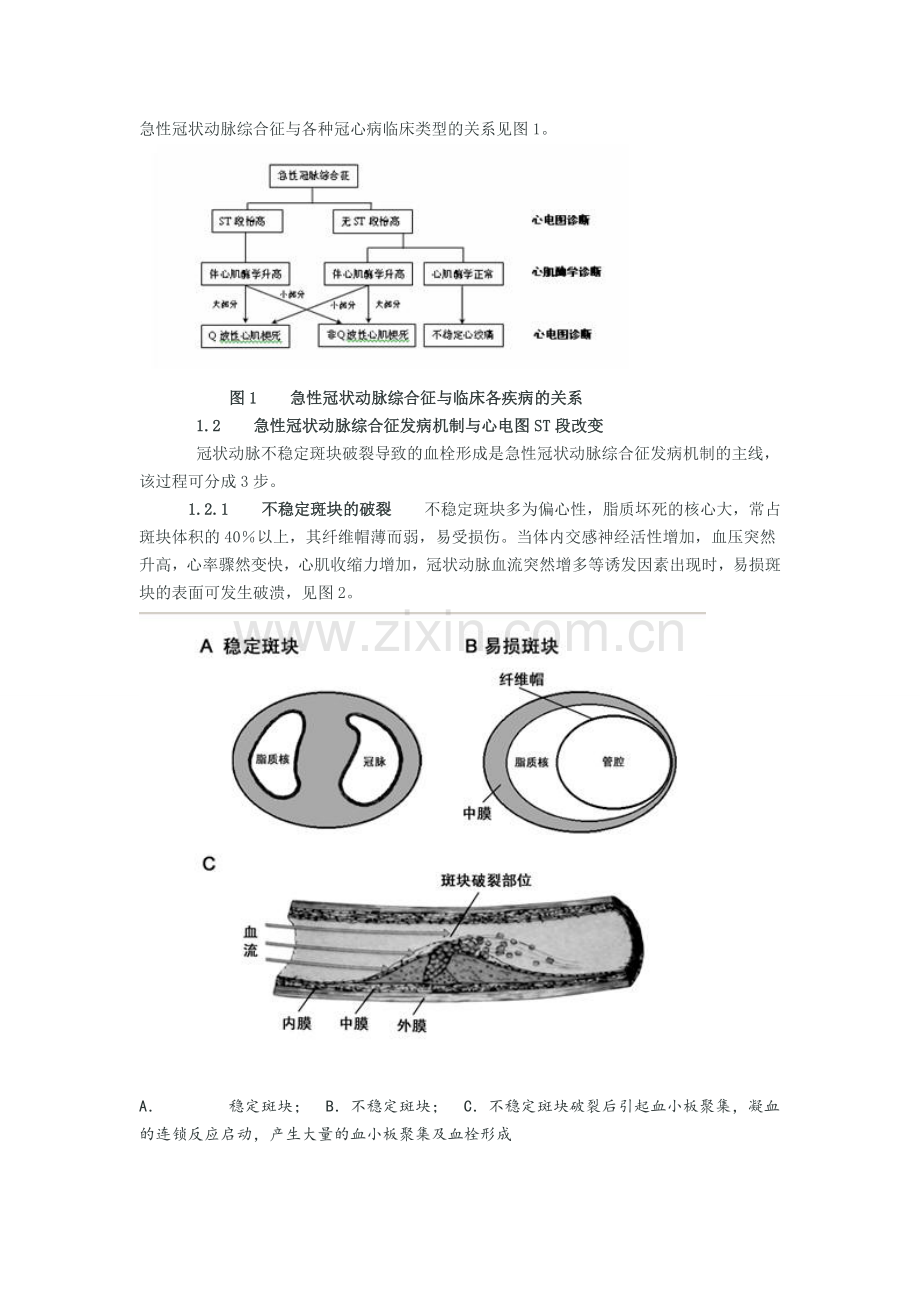 急性冠状动脉综合征心电图.doc_第2页
