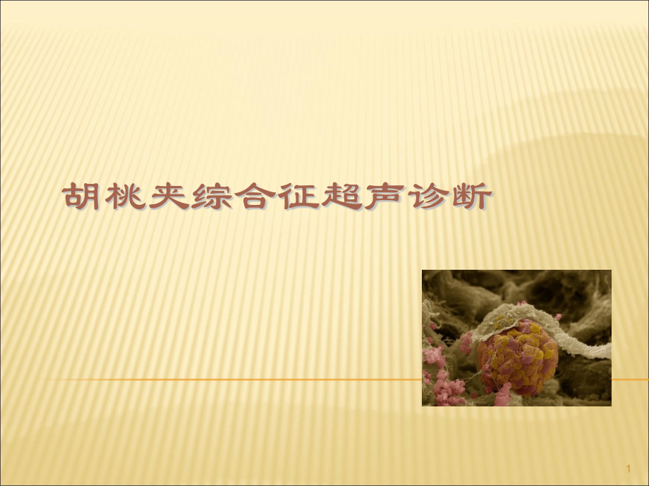 胡桃夹综合征ppt课件.ppt_第1页