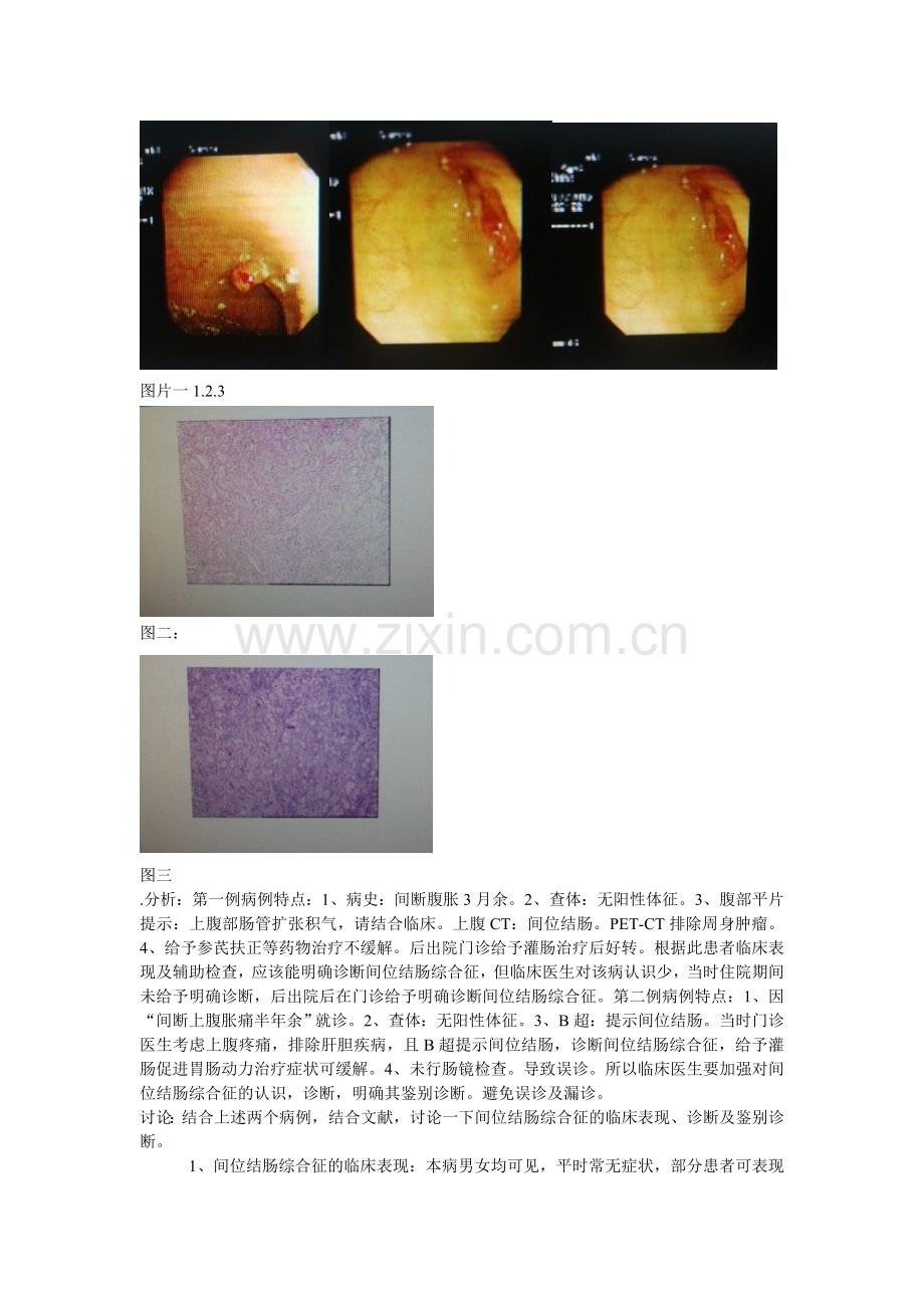 间位结肠综合征.doc_第2页
