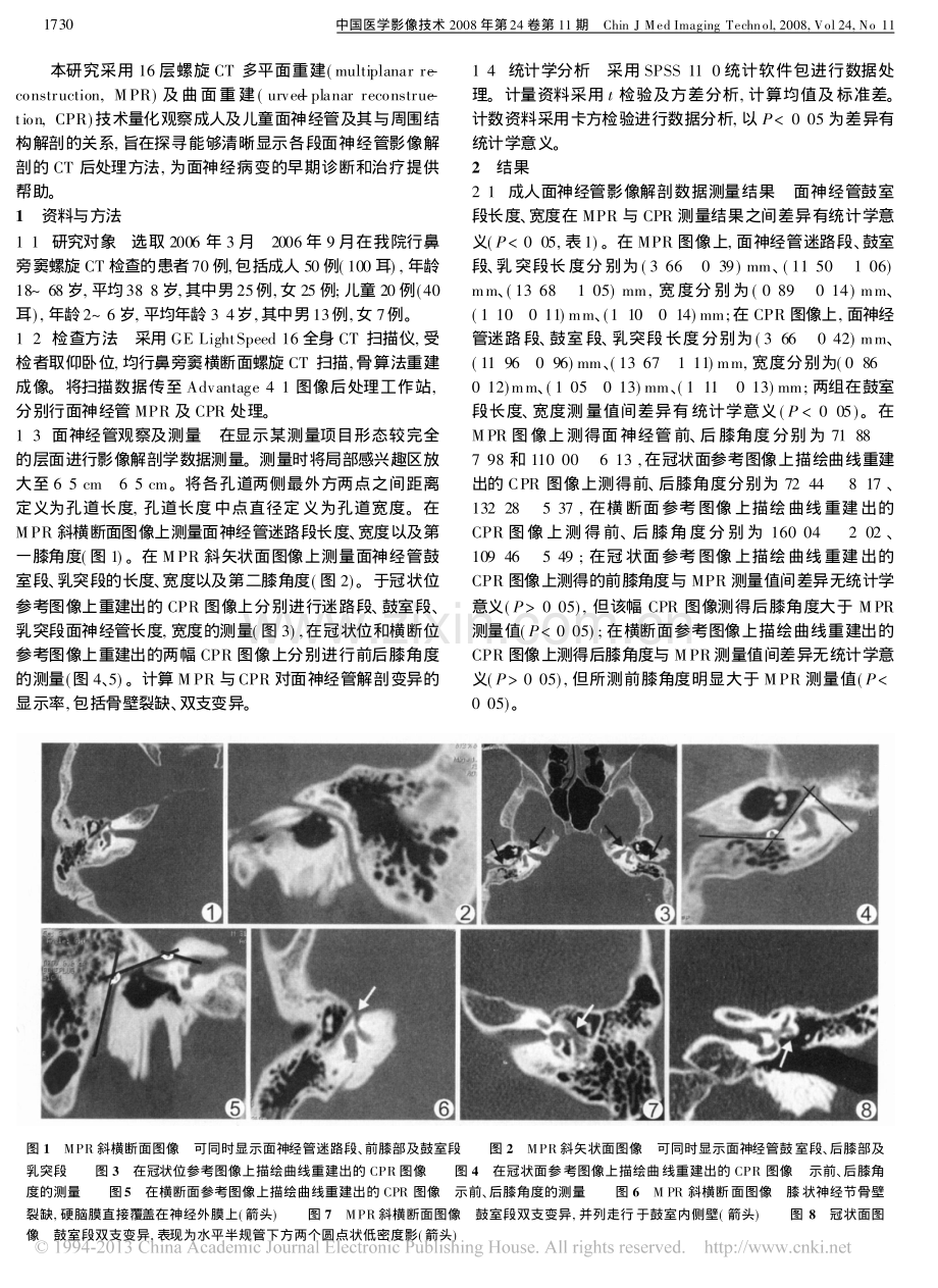 MSCT测量面神经管.pdf_第2页