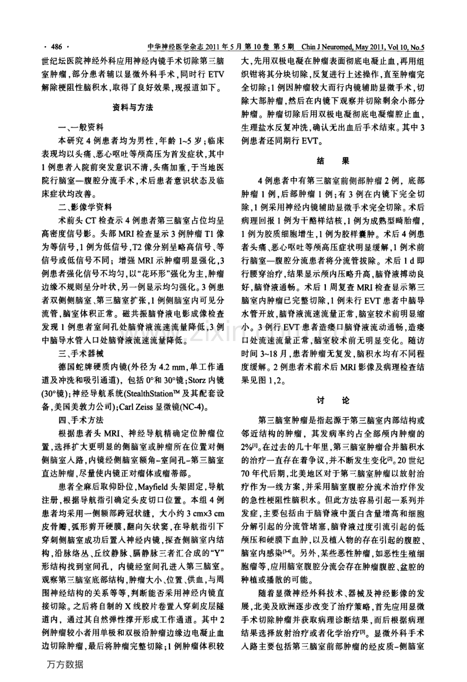 神经内镜治疗第三脑室肿瘤合并脑积水四例报道及文献回顾.pdf_第2页