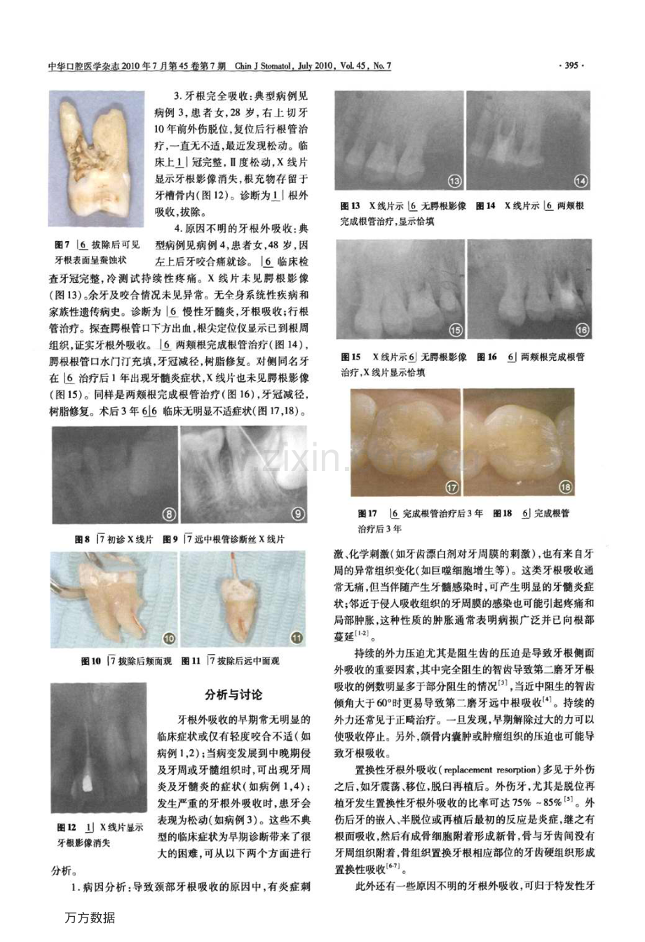 牙根外吸收四例病例分析.pdf_第2页