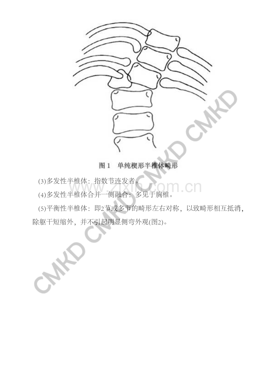 半椎体畸形.pdf_第2页
